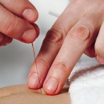 Working hands of acupuncture