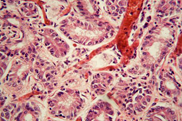 pulmonary embolism under a microscope